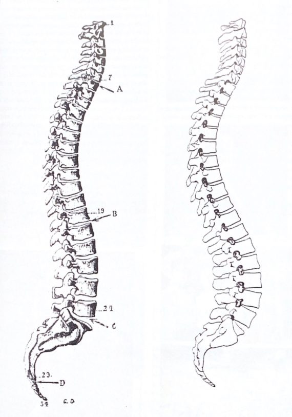 slumped or stacked spines comparison